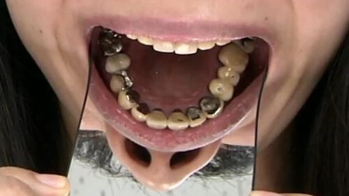 銀歯フェチ銀歯だらけの口内観察 優奈 同人動画