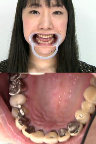 銀歯フェチ銀歯だらけの口内観察 優奈 同人動画