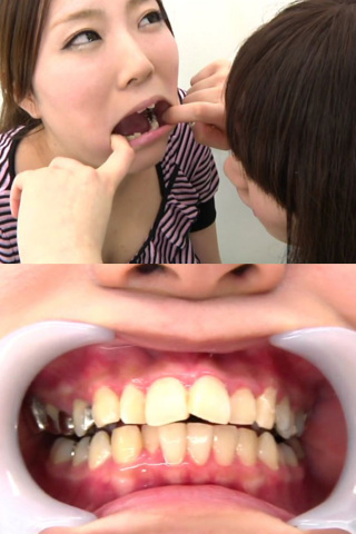 歯フェチ！銀歯たっぷり口内観察レズ　 ひよりちゃん　はるかちゃん 同人動画