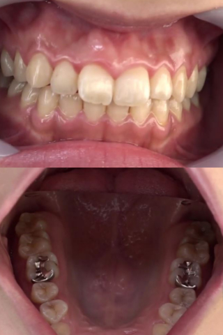 歯フェチ！銀歯観察 桜庭うれあ 同人動画