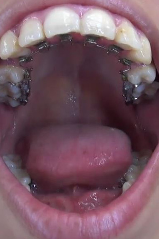 泉水ちゃんの歯・口内自撮り 矯正歯 同人動画