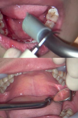【歯科治療】『歯周病！？歯肉縁下歯石除去』　星野桃子 同人動画