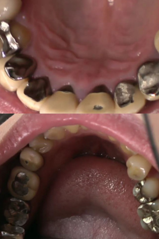 銀歯フェチ銀歯だらけの口内観察 優奈 同人動画