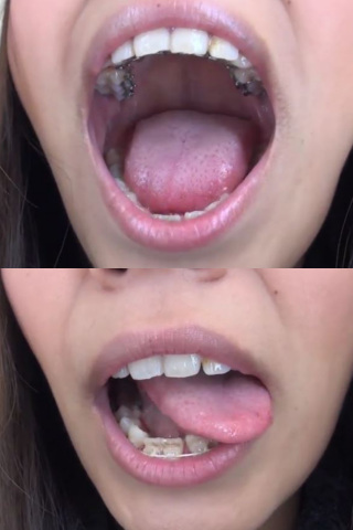 泉水ちゃんの歯・口内自撮り 矯正歯 同人動画