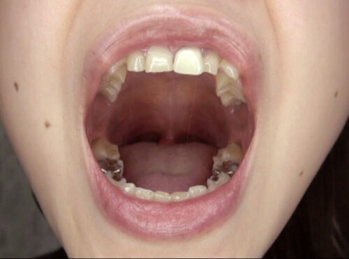 300人のおくち 3